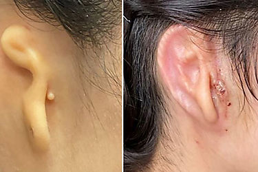 Una mexicana recibe un implante de oído fabricado en 3D con sus propias células en un primer ensayo clínico en humanos