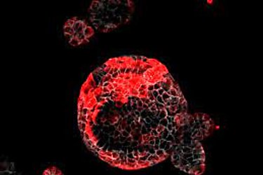 Científicos descubren las células malignas responsables de la recaída en el cáncer de colon