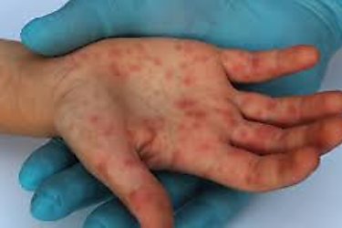 Diez nuevos casos de viruela símica en la última semana