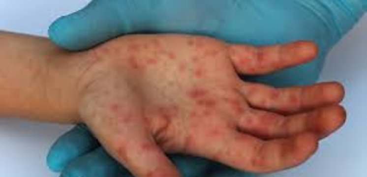 Panam reporta 4 casos nuevos de viruela smica